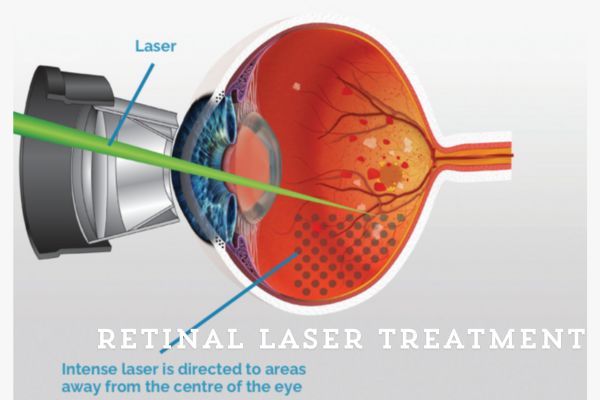 Retinal laser treatment